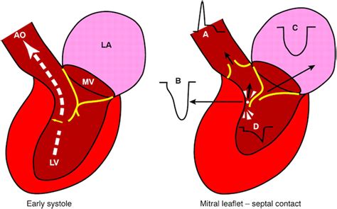 lv outflow tract|left ventricular outflow tract.